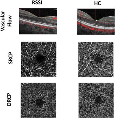 Macula Structure and Microvascular Changes in Recent Small Subcortical Infarct Patients